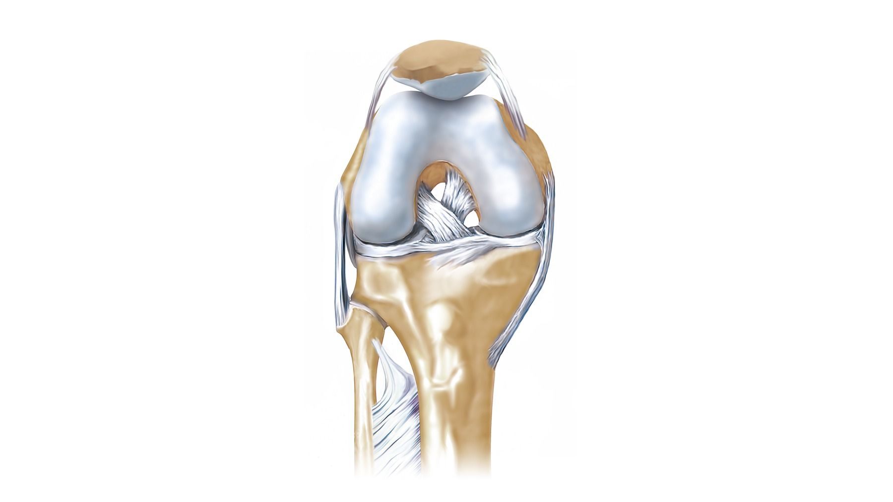 Cruciate ligament rupture